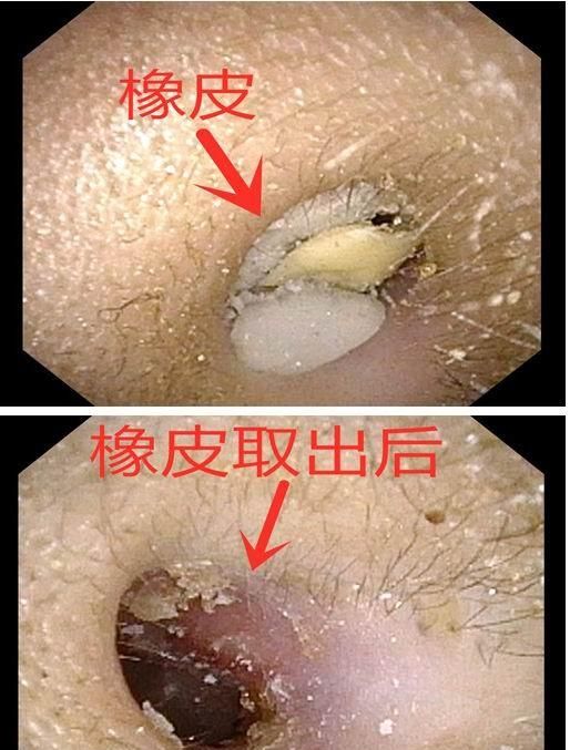 耳朵里的蜜蜂怎么拿出来好图1