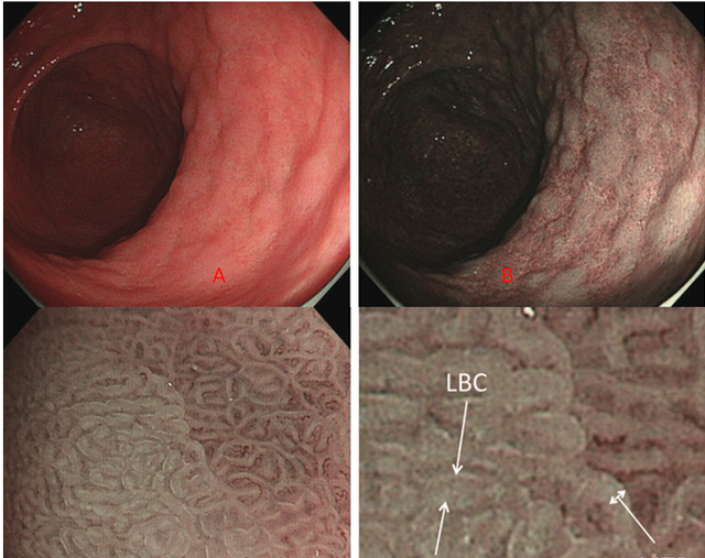 肠上皮化生的内镜诊断(肠上皮化生可以内镜干预吗)图2