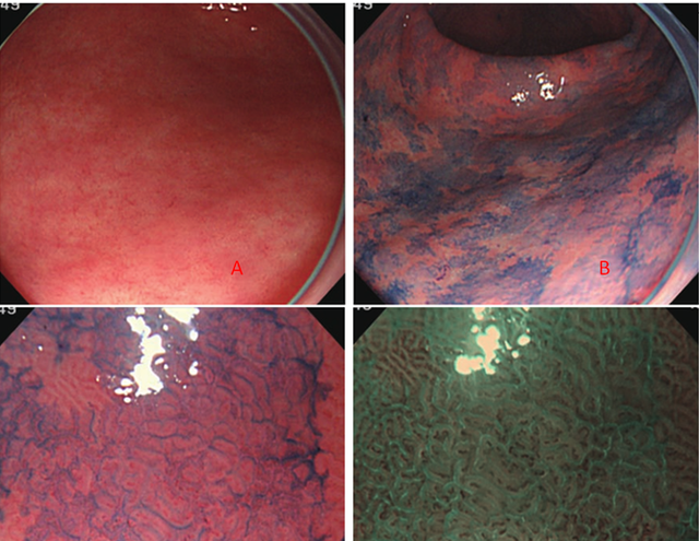 肠上皮化生的内镜诊断(肠上皮化生可以内镜干预吗)图3