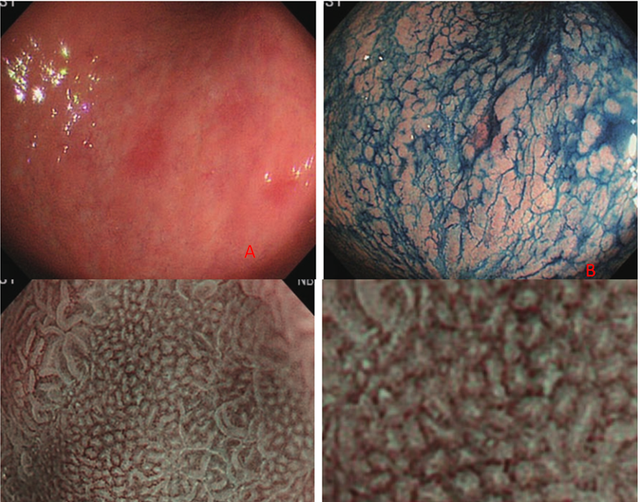 肠上皮化生的内镜诊断(肠上皮化生可以内镜干预吗)图4
