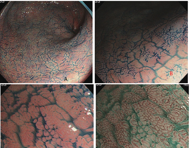 肠上皮化生的内镜诊断(肠上皮化生可以内镜干预吗)图6