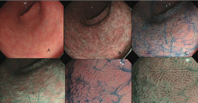 肠上皮化生的内镜诊断(肠上皮化生可以内镜干预吗)图7