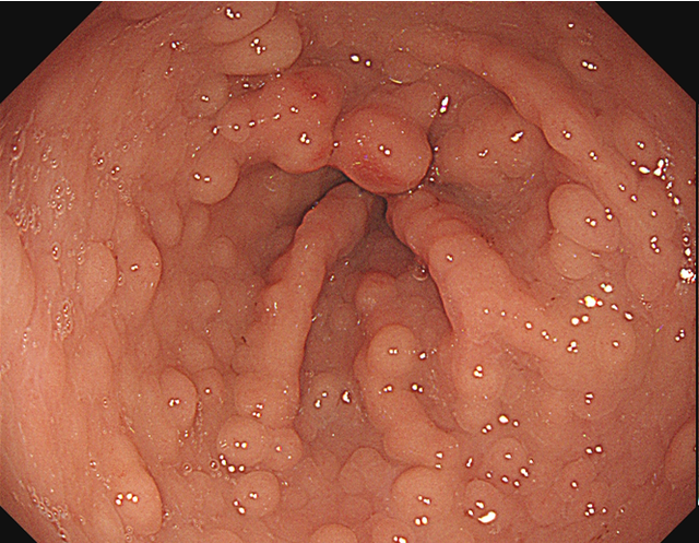 肠上皮化生的内镜诊断(肠上皮化生可以内镜干预吗)图8