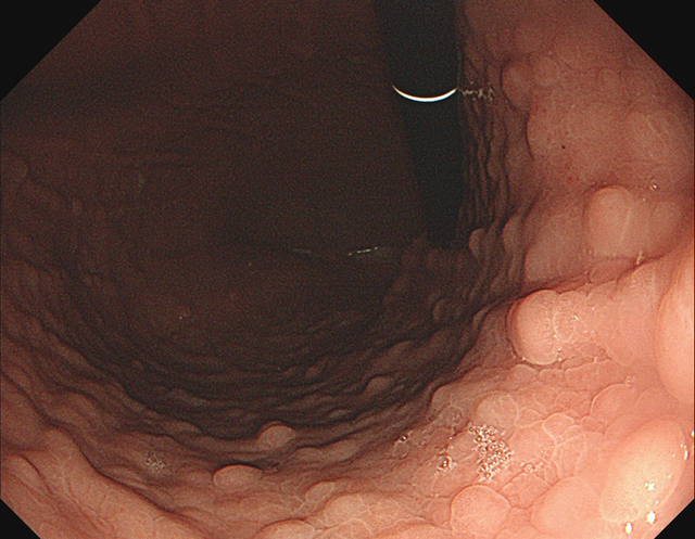 肠上皮化生的内镜诊断(肠上皮化生可以内镜干预吗)图10
