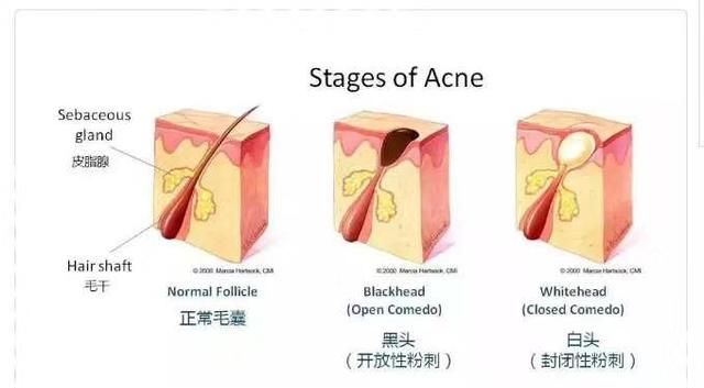 脸上经常出油怎么快速解决图1