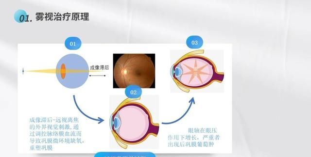 雾视疗法怎么配镜,雾视镜的雾视量怎么算图4