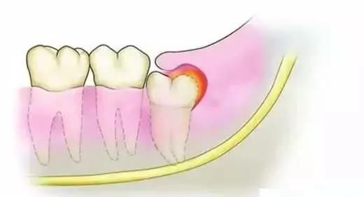 智齿该怎么解决?拔好还是不拔好图1
