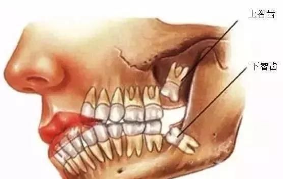智齿该怎么解决?拔好还是不拔好图4