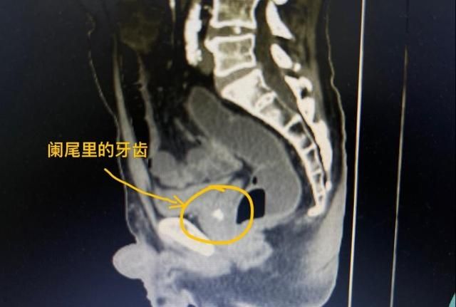 半颗碎牙引发阑尾炎图1