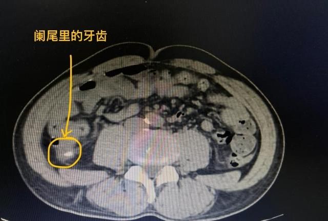 半颗碎牙引发阑尾炎图2