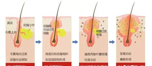 为什么我一到青春期就长痘痘,青春期前胸后背长痘痘怎么办图3