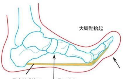 为什么脚后跟会疼怎么办图5