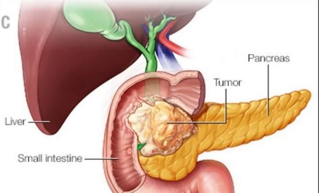 胰腺炎怎么治疗,胰腺炎怎么治疗最快最好图1