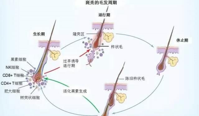 斑秃怎么治疗最好最快最有效图3