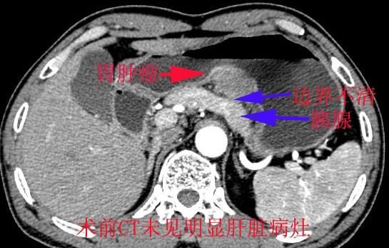 胃癌能活多久,胃癌扩散能活多久图2