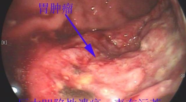 胃癌能活多久,胃癌扩散能活多久图3