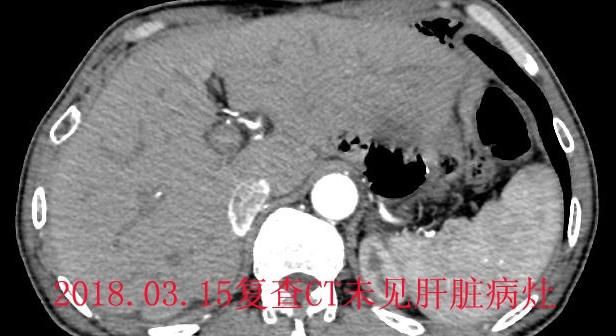 胃癌能活多久,胃癌扩散能活多久图4