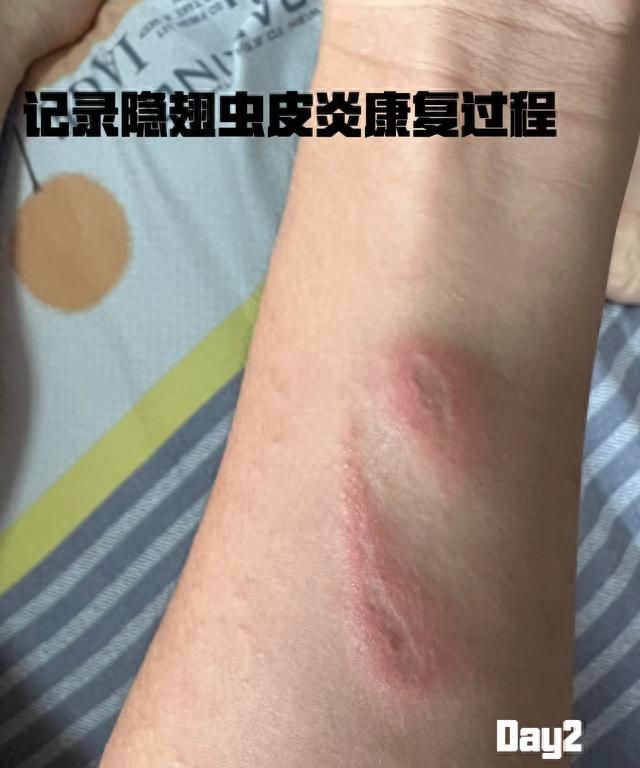 隐翅虫蜇人后留下的痕迹(隐翅虫蜇人出现什么样症状)图4