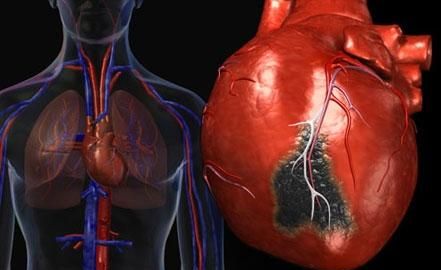 心肌梗塞是怎么引起的图2