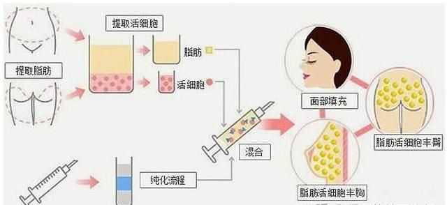 用什么材料隆鼻最自然图8