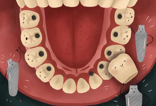 种植牙哪种种植体最好图1